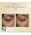 نتیجه قبل و بعد از استفاده کرم شب رتینول RoC - Retinol Correxion Deep Wrinkle Night Cream before after