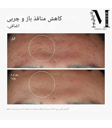 قبل و بعد از استفاده سرم نیاسینامید اوردینری 10% + زینک 1% 8 هفته the ordinary niacinamide 10% zinc 1% serum before after