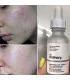 قبل و بعد از استفاده سرم نیاسینامید اوردینری 10% + زینک 1% the ordinary niacinamide 10% zinc 1% serum before after