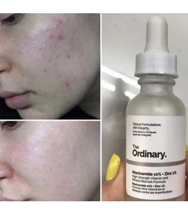 قبل و بعد از استفاده سرم نیاسینامید اوردینری 10% + زینک 1% the ordinary niacinamide 10% zinc 1% serum before after