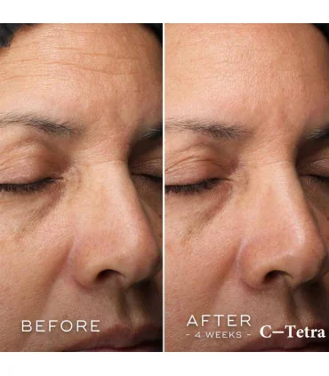 قبل و بعد از استفاده سرم ویتامین سی مدیک 8 مدل C-Tetra