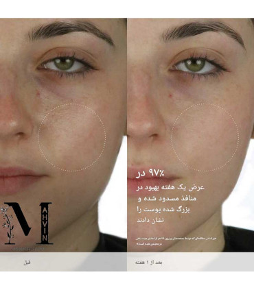 تصویر مقایسه قبل و بعد استفاده از واتر کرم تاچا و تاثیر آن روی کنترل چربی و شفافیت پوست