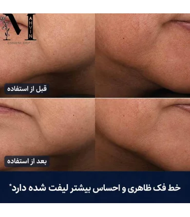 نتیجه قبل و بعد استفاده از کرم سوپریم استی لادر (Estée Lauder) Revitalizing Supreme+ با بهبود سفتی پوست و لیفت خط فک