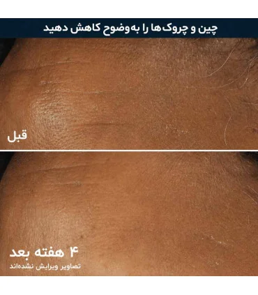تصویر قبل و بعد از استفاده از کرم روز رتینول روک SPF30 بعد از 4 هفته