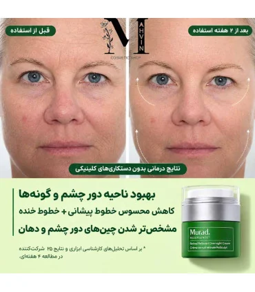 بهبود چروک‌های عمیق قبل و بعد از استفاده کرم ضد چروک مورد