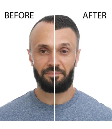 قبل و بعد از استفاده از آمپول بیوتین بپانتین اصل برای درمان ریزش مو Bepanthene Biotin