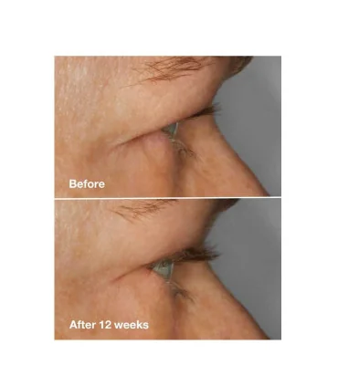 سرم تقویت مژه کلینیک قبل و بعد از استفاده