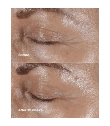 کرم دور چشم ضدچروک اسمارت کلینیکال ریپیر قبل و بعد از استفاده