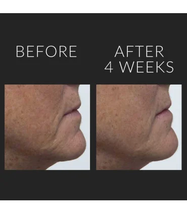 سرم لیفت صورت و ضد پیری کیت سامرویل Kate Somerville قبل و بعد از استفاده - سرم لیفت صورت و ضد پیری کیت سامرویل Kate Somerville