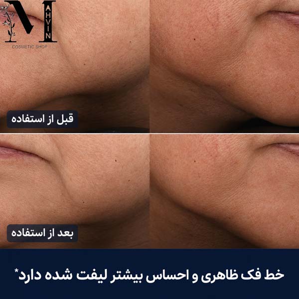نتیجه قبل و بعد استفاده از کرم سوپریم استی لادر (Estée Lauder) Revitalizing Supreme+ با بهبود سفتی پوست و لیفت خط فک