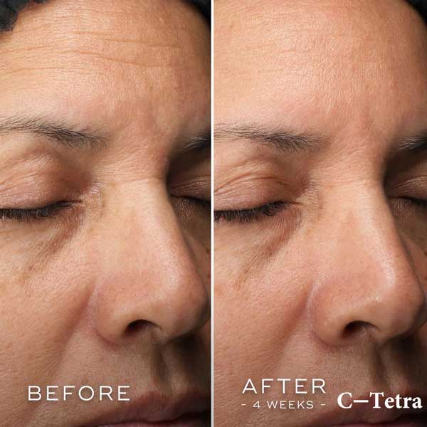 قبل و بعد از استفاده سرم ویتامین سی مدیک 8 مدل C-Tetra