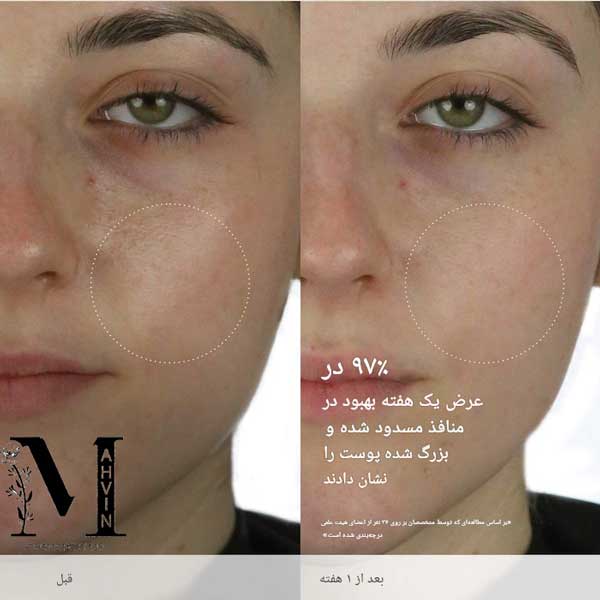 قبل و بعد از استفاده واتر کرم تاچا